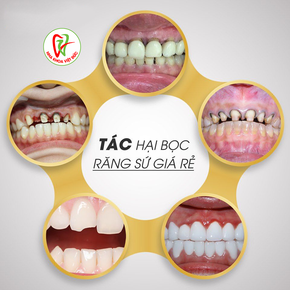 TÁC HẠI CỦA BỌC RĂNG SỨ GIÁ RẺ