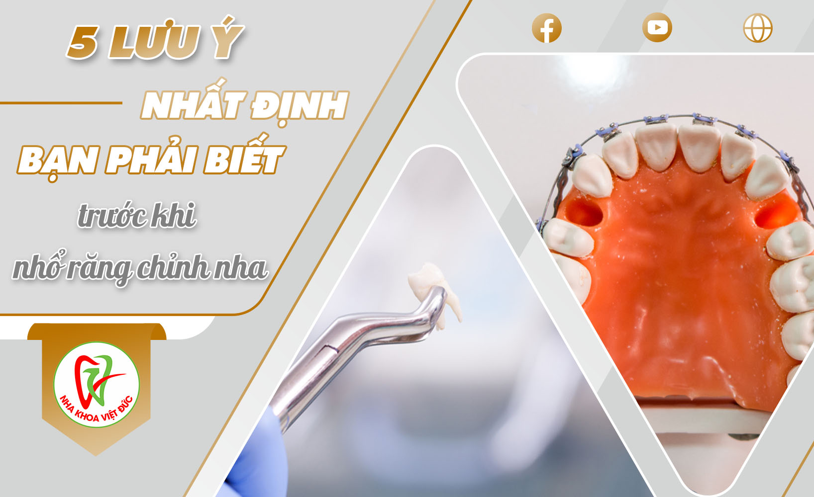 5 LƯU Ý NHẤT ĐỊNH BẠN PHẢI BIẾT TRƯỚC KHI NHỔ RĂNG CHỈNH NHA